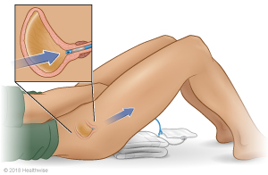 Person on his or her back, gently removing a Foley catheter