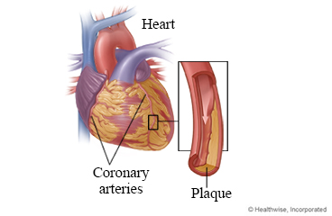 Coronary arteries and plaque in an artery