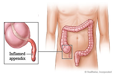 Location of appendix in belly, with detail of inflamed appendix.