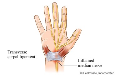 The hand's nerves, tendons, and carpal tunnel syndrome