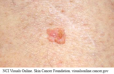 Squamous skin cancer
