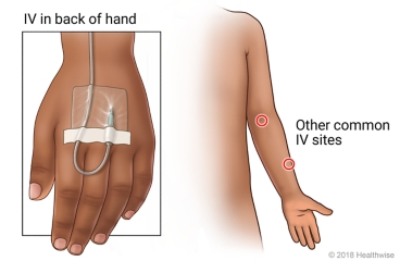 Common I.V. sites on arm, with close-up of I.V. on back of child's hand.