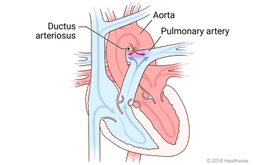 Heart showing patent ductus arteriosus and change in blood flow