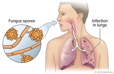 Closeup of fungus spores, inhaled through nose into lungs and causing infection in lungs.