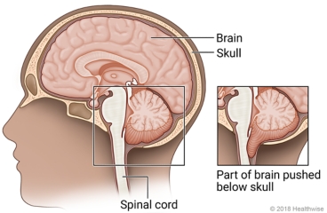 Inside view of the head, with detail of part of the brain pushed below the skull