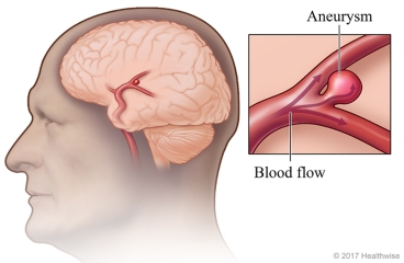 Aneurysm in brain, with detail of bulge in artery