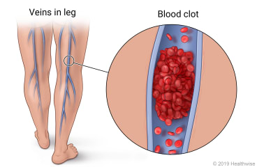 Location of deep veins in the legs, with detail of blood clot in vein