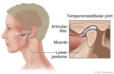 Areas of pain from TMD, with detail of TM joint showing articular disc, muscle, and lower jawbone.