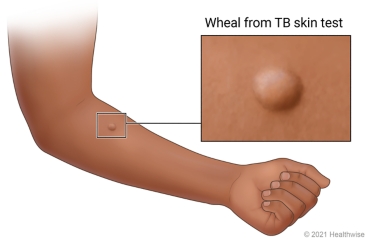 Inner forearm with raised wheal from TB skin test.