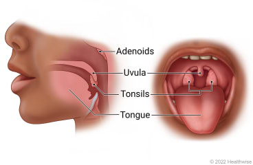 Side and open-mouth views of child's mouth and throat, showing adenoids, uvula, tonsils, and tongue.