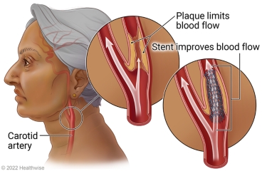 Carotid artery on side of neck, with detail of inside the artery showing plaque limiting blood flow and detail of inserted stent improving blood flow.