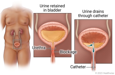 Urinary tract in person, with detail of urine retained in bladder above blockage in urethra and detail of catheter inserted into urethra to drain urine from bladder.