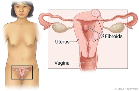 Female reproductive organs in pelvis, including uterus and vagina, with detail showing fibroids growing on the outer and inner wall of the uterus, and inside the wall of the uterus.