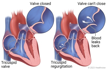 A heart showing the tricuspid valve, with detail of a closed valve, and a heart showing valve that can't close letting blood leak back into atrium.