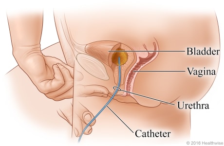 Side view showing catheter inserted through the urethra and into the bladder.