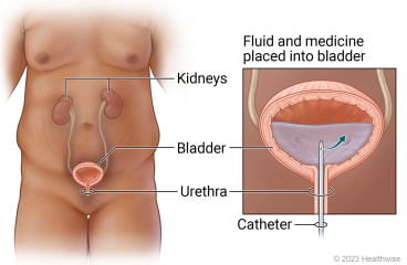 Urinary tract in pelvic area, with detail of catheter put through urethra into bladder to place fluids and medicine in bladder.