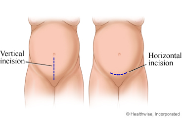 Caesarean incisions, both vertical and horizontal