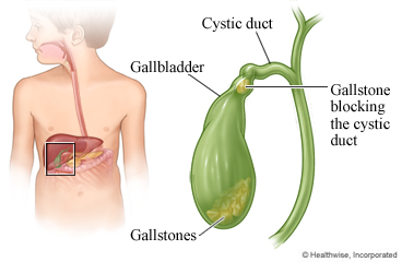 Gallstone in cystic duct