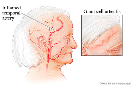 Inflamed temporal artery in the side of the face, near the temple.