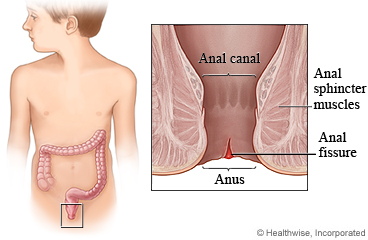 Anal fissure