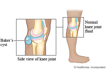 Baker's cyst