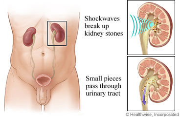 Kidneys and lithotripsy