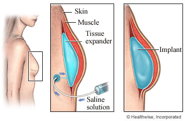 A tissue expander and breast implant after mastectomy