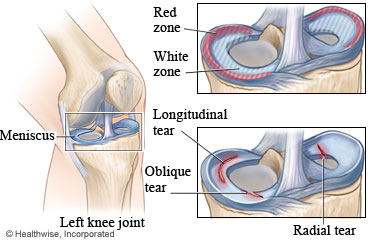 Meniscus tear