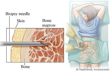 Bone marrow aspiration and biopsy