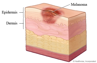 Melanoma