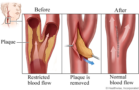 Carotid endarterectomy procedure.