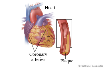 Coronary artery disease