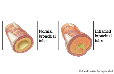 Normal and inflamed airways