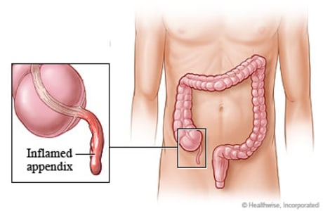 Appendicitis and where the appendix is located in the body.