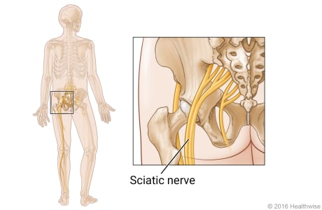 a skeleton showing the location of the sciatic nerve and close-up of the sciatic nerve in the hip area