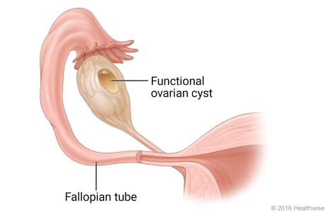 A fallopian tube showing a functional ovarian cyst.