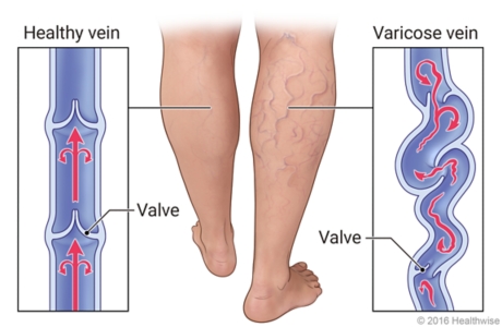 External view of legs with and without varicose veins, with details of healthy vein and twising varicose veins.