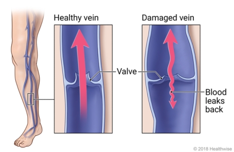 veins in leg, with detail of healthy vein and valve and of damaged vein that allows blood to leak backward.