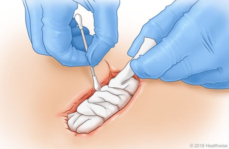 Learning About Packing Your Wound