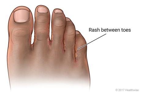 foot with toe web type athlete's foot between toes