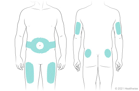 Front and back of body, showing areas where insulin may be injected.
