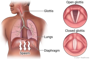 Glottis in throat and lungs in chest above diaphragm, showing diaphragm spasm that causes hiccups, with detail of open glottis and closed glottis.