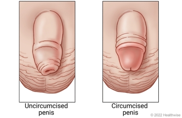 Uncircumcised penis with foreskin still in place and a circumcised penis with foreskin removed.