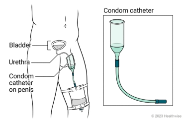Male urinary tract, showing bladder filled with urine, condom catheter on penis, and urine draining into bag strapped on leg.