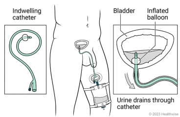Indwelling catheter inserted in penis and through urethra to bladder, with detail of urine draining from bladder into collection bag strapped to leg.