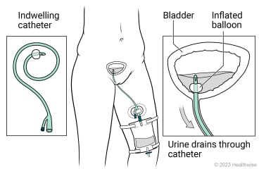 Indwelling catheter draining urine from bladder, with detail of bladder, inflated balloon at end of catheter in bladder, and urine draining through catheter.
