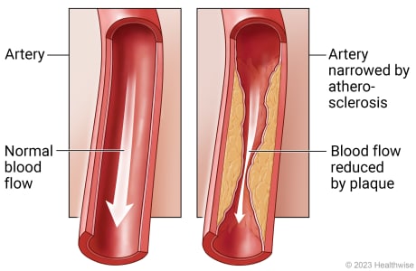 Inside view of artery with normal blood flow compared to artery affected by atherosclerosis, with blood flow reduced by plaque.