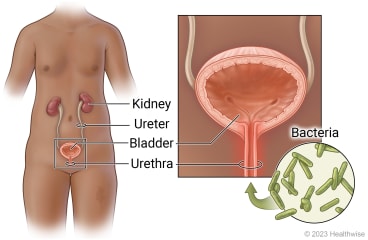 Urinary tract in female teen, showing kidney, ureter, bladder, and urethra, with detail of bacteria entering urethra to bladder.