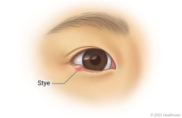 Stye on lower lid of child's eye.