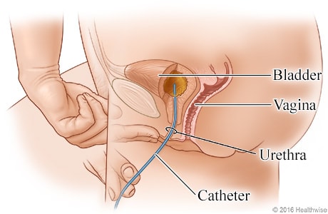 Side view showing catheter inserted through the urethra and into the bladder.